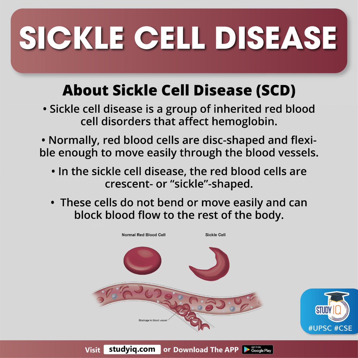 upsciq's tweet photo. Sickle Cell Disease
#sicklecelldisease #sicklecellanaemiaeliminationmission #pmofindia #pmmodi #narendramodi #bloodcell #redbloodcells #bloodvessels #sickle #blockbloodflow #humanbody #celldisease #anemia #periodicepisodes #visionproblems #sed #stemcell #bonemarrow #upsc #cse https://t.co/daOIXuokiW