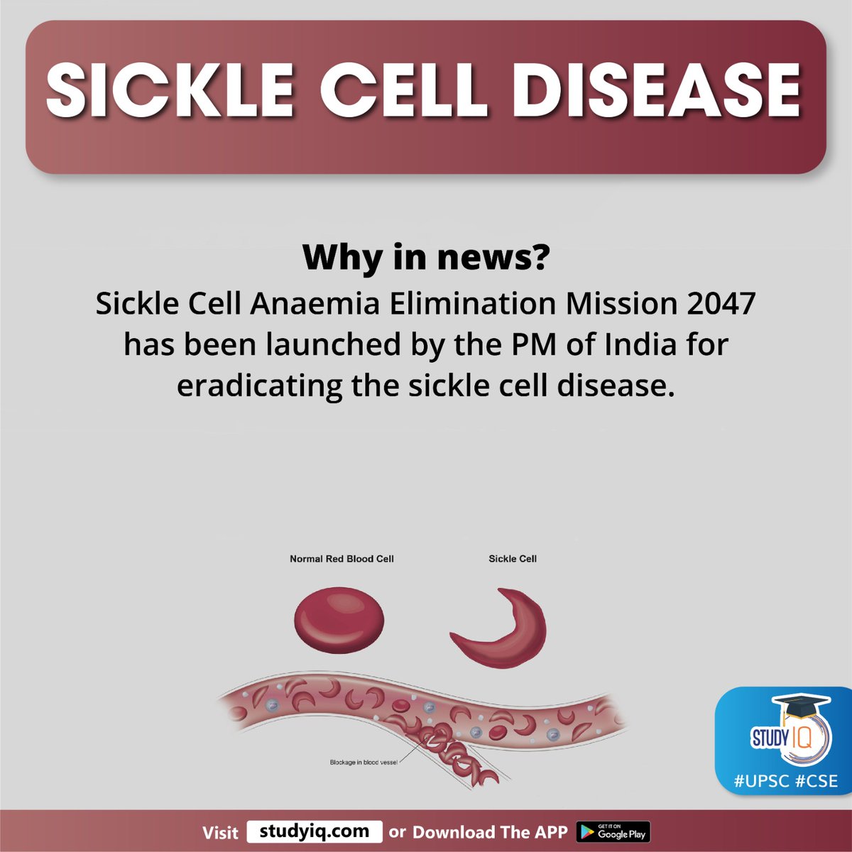 upsciq's tweet photo. Sickle Cell Disease
#sicklecelldisease #sicklecellanaemiaeliminationmission #pmofindia #pmmodi #narendramodi #bloodcell #redbloodcells #bloodvessels #sickle #blockbloodflow #humanbody #celldisease #anemia #periodicepisodes #visionproblems #sed #stemcell #bonemarrow #upsc #cse https://t.co/daOIXuokiW