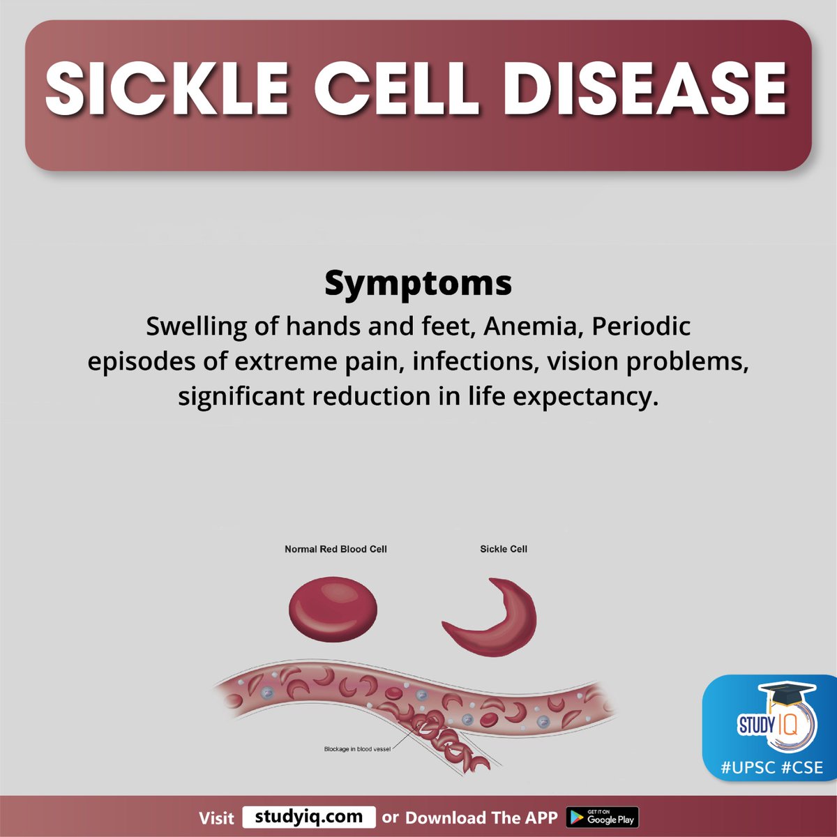 upsciq's tweet photo. Sickle Cell Disease
#sicklecelldisease #sicklecellanaemiaeliminationmission #pmofindia #pmmodi #narendramodi #bloodcell #redbloodcells #bloodvessels #sickle #blockbloodflow #humanbody #celldisease #anemia #periodicepisodes #visionproblems #sed #stemcell #bonemarrow #upsc #cse https://t.co/daOIXuokiW