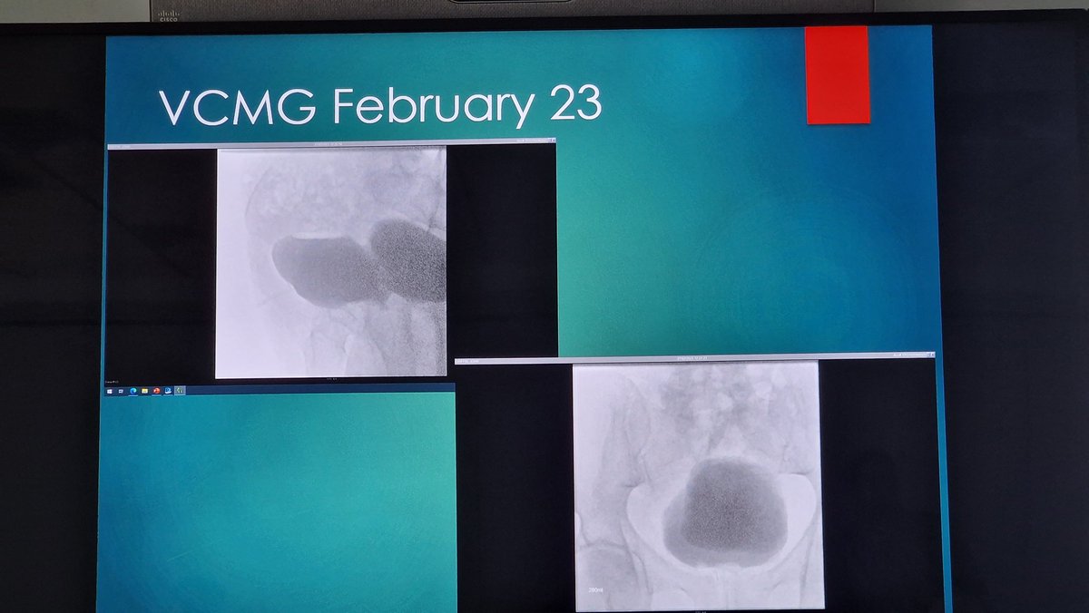 St George's Urology (@georgesurology) on Twitter photo Wed AM Teaching from our 🌟 #physcianassociate <a href="/mikaelacarey/">Mikaela Carey</a> on our case series of 🤖 assisted diverticulectomy. Consider managing moderate/large diverticulum first prior to BOO intervention. #LUTs <a href="/Issarami/">Rami Issa</a> <a href="/HARQazi/">Hasan Qazi</a> <a href="/seth_bladders/">Jai Seth</a> <a href="/sharma_DMS/">Davendra</a> <a href="/DenosshanSri/">Denosshan Sri</a> <a href="/PaoloUmari/">Paolo Umari</a> Wed AM Teaching from our 🌟 #physcianassociate <a href="/mikaelacarey/">Mikaela Carey</a> on our case series of 🤖 assisted diverticulectomy. Consider managing moderate/large diverticulum first prior to BOO intervention. #LUTs <a href="/Issarami/">Rami Issa</a> <a href="/HARQazi/">Hasan Qazi</a> <a href="/seth_bladders/">Jai Seth</a> <a href="/sharma_DMS/">Davendra</a> <a href="/DenosshanSri/">Denosshan Sri</a> <a href="/PaoloUmari/">Paolo Umari</a>
