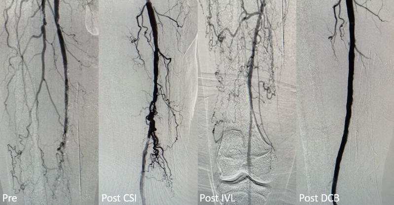ShockwaveIVL's tweet photo. A successful #ShockwaveIVL case at Ochsner Hospital in Baton Rouge, LA! Patient had an SFA CTO. The team debulked with 1.5 solid Diamondback, cracked the calcium with 6.0x60 #ShockwaveM5Plus and finished with a DCB for an exceptional result.
ISI https://t.co/sZ0NdzXNcV https://t.co/UVaJp9ZbOI