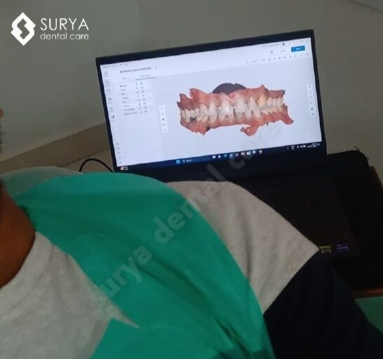 Intraoral scanners (IOS) capturing the direct optical impressions! It will increase the accuracy of dentistry!

#suryadentalcare #dentistry #intraoralscanner #digitaldentistry #scanner #digitalimpression #technology #smile #dentallife