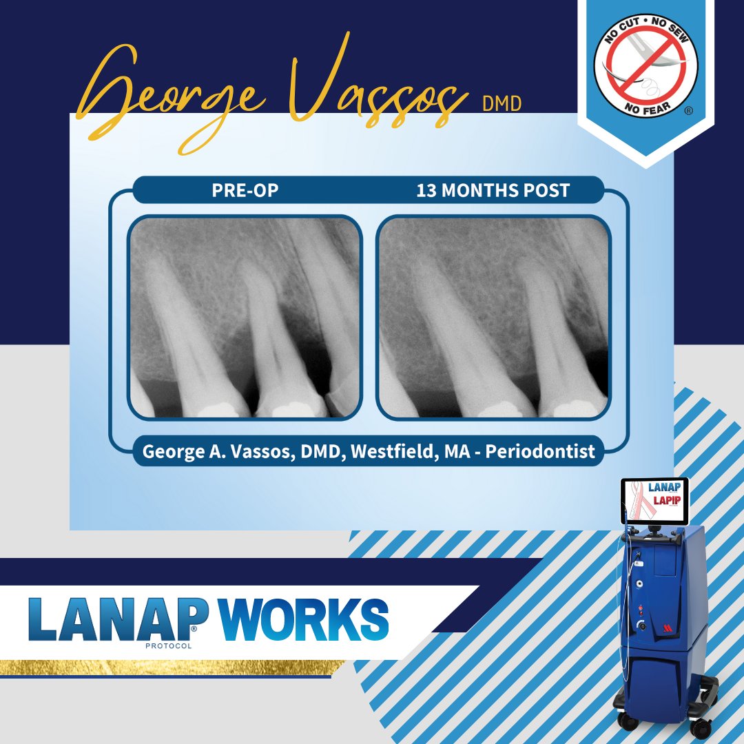 PerioLase4LANAP's tweet photo. The #LANAP protocol with the #PerioLase MVP-7 is a tissue-preserving, regenerative, and bone-building procedure. The LANAP=LAR treatment returns the periodontium to a natural state of health. #LANAPworks #GCDC #GCDC2023 #DentalXP #DentalXPsymposium #PerioLaseMVP7 #Dentistry https://t.co/l8LbYuWaZP
