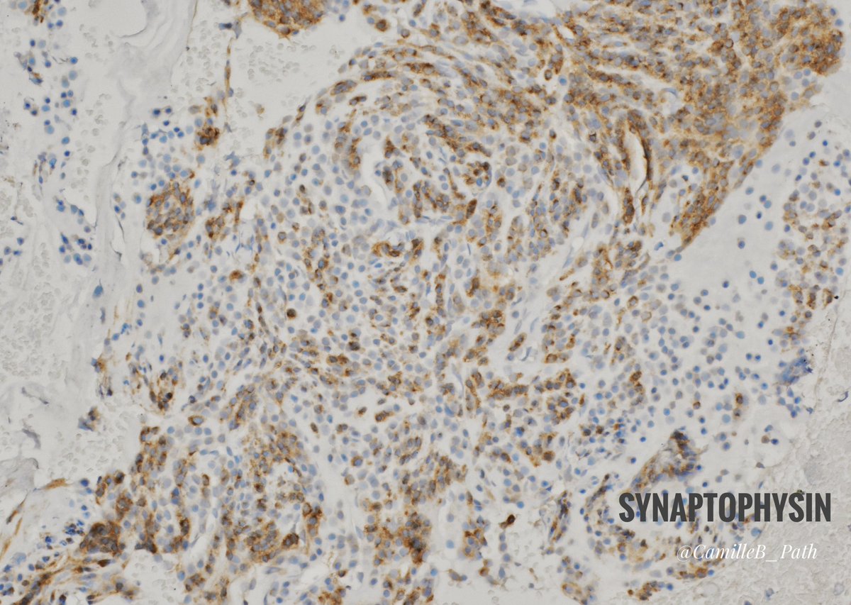 A potential neuroendocrine tumor mimicker 👀
Context: submucosal gastric mass. Surounding gastric biopsy are normal (no autoimmune gastritis)
Any thoughts?
#GIPath