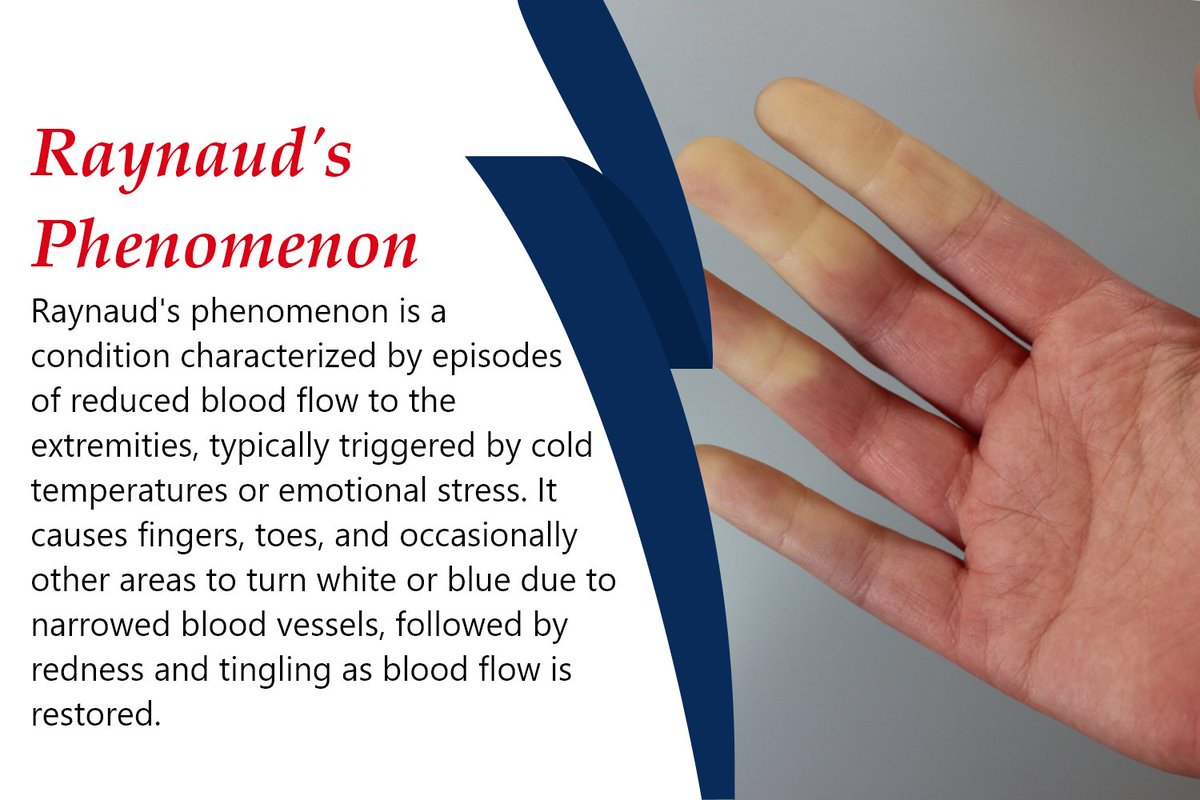 Raynaud's phenomenon is a problem that causes decreased blood flow to the fingers.
#Raynaudsphenomenon #VirtualHealthVisit #OnlineHealthConsultation #TelemedicinePlatform #DigitalHealthServices #VirtualMedicalConsultation #OnlineDoctorVisit
umbrellamd.com