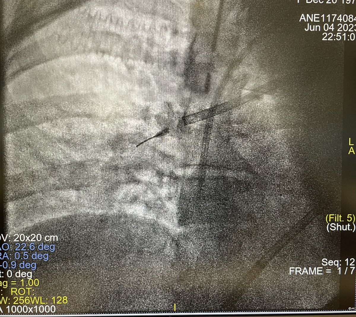 de_clinico's tweet photo. 👩‍🦳 50 a... disnea intensa, acude a urgencias... TEP masivo➡️PCR➡️RCP avanzada➡️Cath Lab➡️ECMO-RCP➡️trombectomía➡️retirada ECMO VA en 48 hrs... alta a domicilio en 3 semanas... trabajo multidisciplinar UCI-Cardiología-C Vascular-Rx- Neumología https://t.co/saNydywAGP