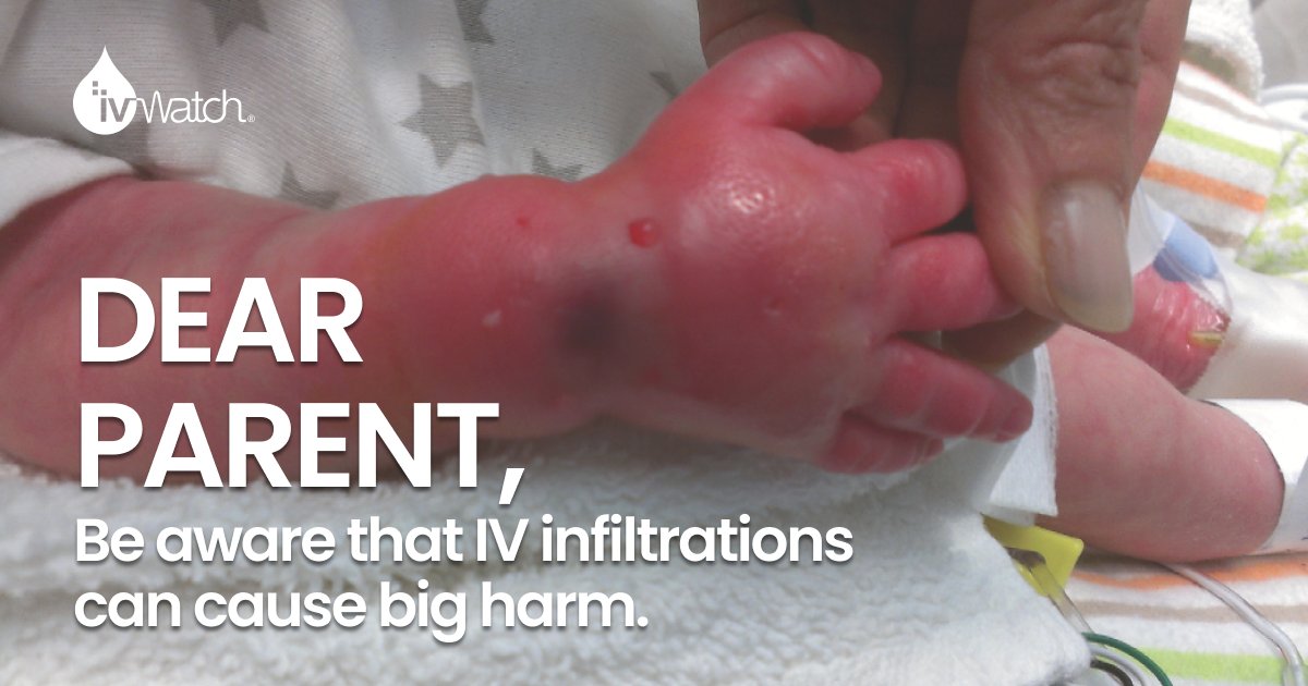 ivWatch's tweet photo. The nurse took two hours to place the IV and it still went bad. A bad IV is a bad IV. You can be your child’s voice. Be vigilant and look for signs of an IV going bad.
Read the blog to learn more: https://t.co/cYf5tM5a4h https://t.co/idEEJXKETs