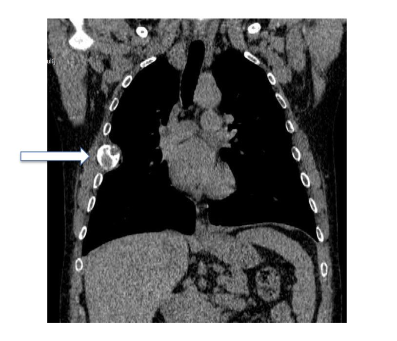 What would be your differential diagnosis and treatment strategy when you see these cystic/lytic lesions just pre-transplant? (PTH: 2411 pg/mL)

You can check our team’s approach in the latest issue of <a href="/turkjnephrol/">Turkish Journal of Nephrology</a> 

turkjnephrol.org/en/confu-tumor…