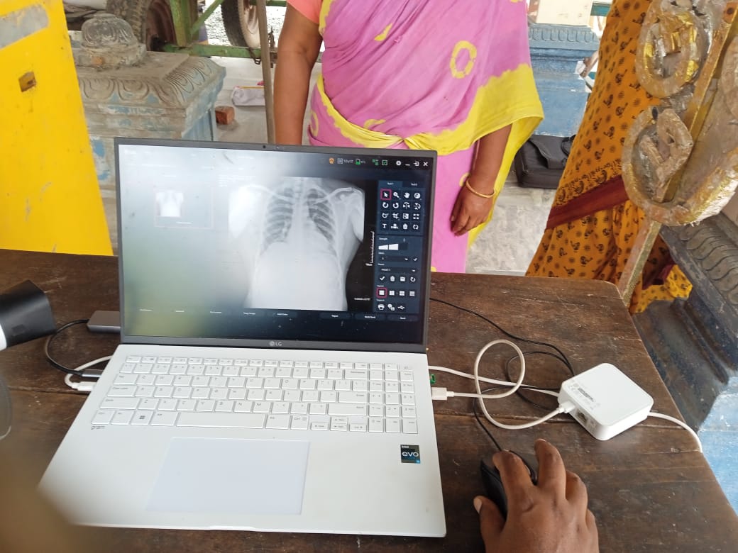 TBMBAPuducherry's tweet photo. ACF CXR Screening mike announcement,IEC campaign M.Palayam 05.07.2023with the team consisting of Ms.GnanaselviDot.Spr, Mrs.Sutha TBHV,Mr.Sunder LT,ANM,ASHAand State IEC Officer Mr.Manimaran underthe guidance of Dr.Venkatesh STO Puducherry#CMPuducherry #DDG2017 #EndTB https://t.co/ikOOaQprdh