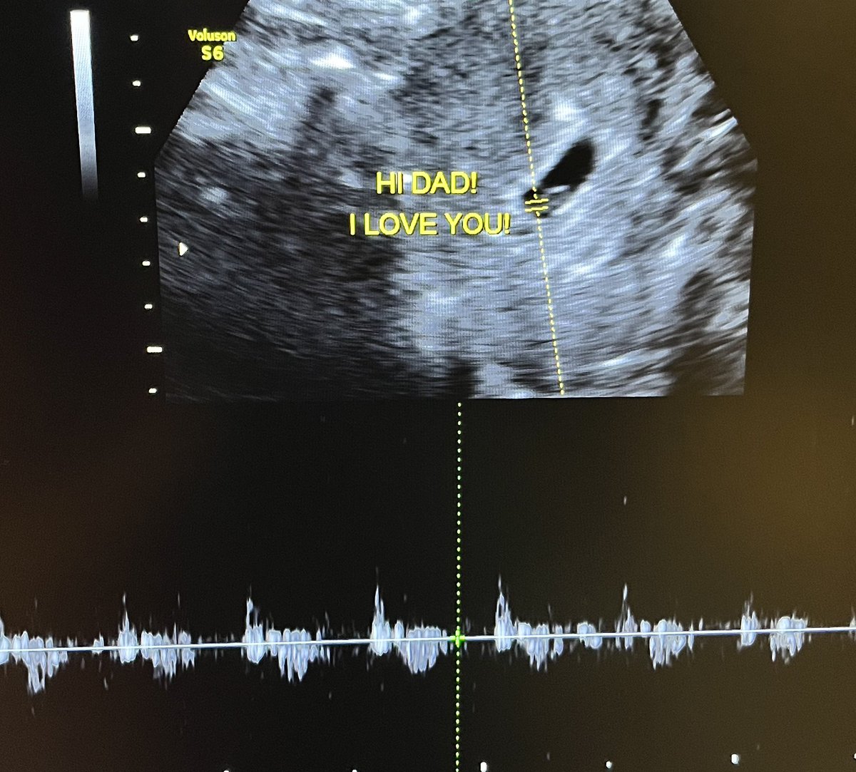 So far we have another successful Abortion Pill Reversal! 🙏🏻

Mom got the abortion pill online from India. She said she immediately felt instant regret. She called our hotline & had her first dose of progesterone within 4 hours.

#lifesconnection #AbortionPillReversal #ultrasound