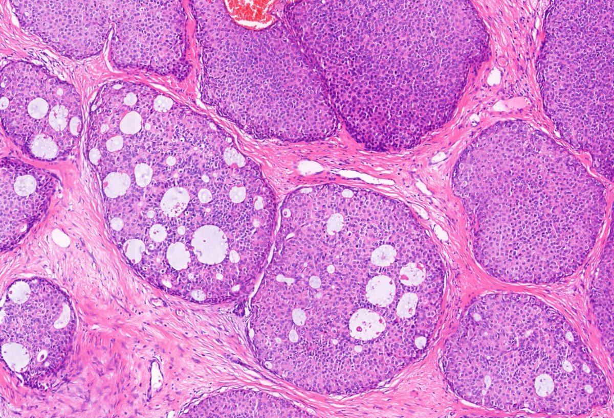 #dermpath #breastpath 
if no demographics, can you make a diagnosis?
<a href="/DrGeeONE/">Olaleke Folaranmi</a> <a href="/kis_lorand/">Lorand Kis</a> <a href="/pepeheffernan/">Pepe Jiménez Heffernan</a> <a href="/PIorfino/">Dermpath_doc_trish</a> <a href="/et565/">Etan Marks, DO</a> <a href="/MarcelaSaebL/">Marcelasaeblima.</a> <a href="/atman_ci/">Dr. Luca</a> <a href="/gonzadetoro/">Gonzalo De Toro</a> @ArjunRamaiya1 <a href="/ChristineJKoMD/">Christine J. Ko, MD</a> <a href="/JacobSmalberger/">Jacob Smalberger, M.D.</a> <a href="/DiegoMoralesN/">Diego Morales, MD</a>