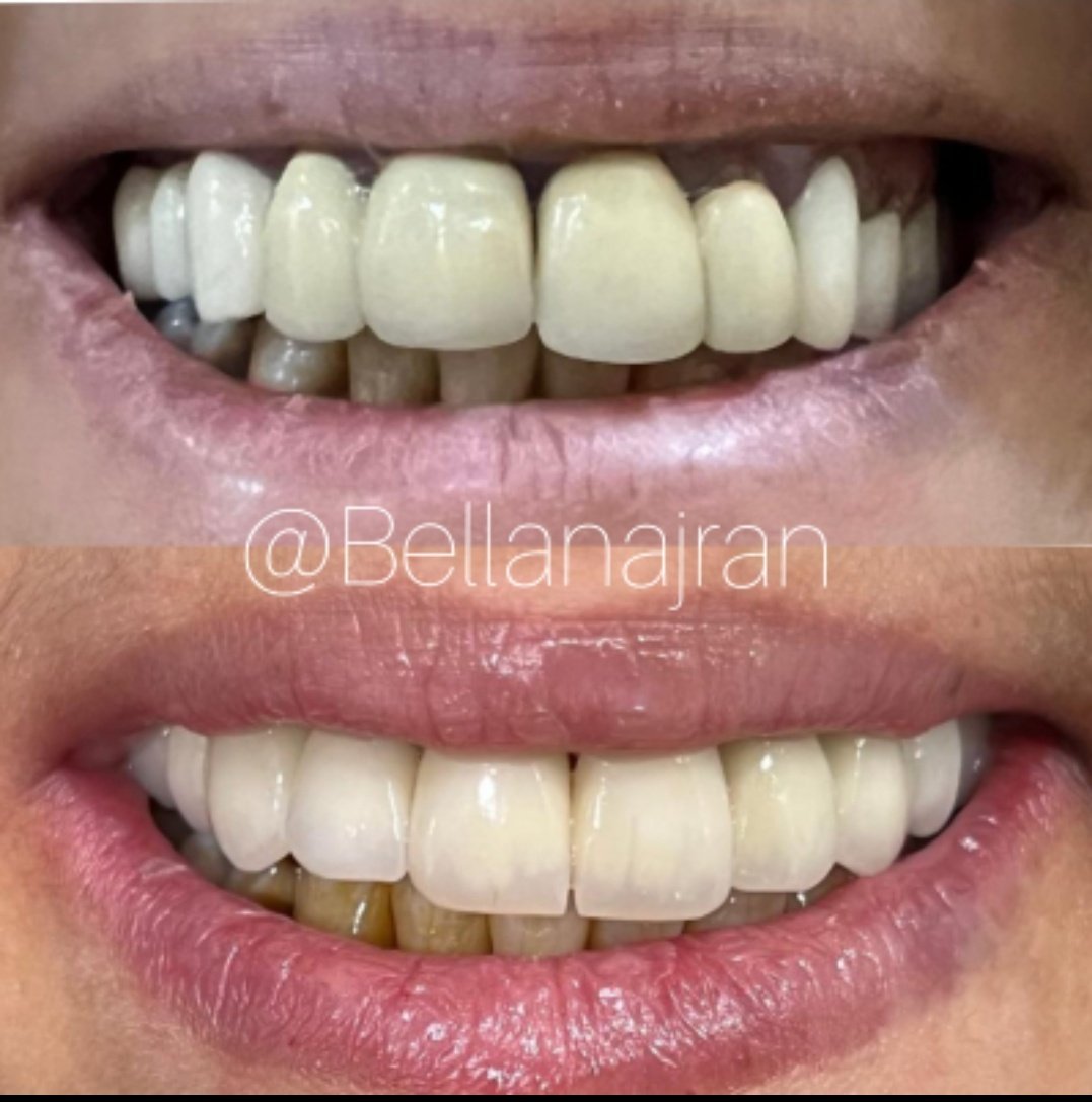 bdentclinics's tweet photo. إستشاريون متخصصون في جميع تخصصات طب الأسنان .
عالج أسنانك بالشكل الصحيح لانها خلقت  لتبقى 🦷 🤍
للحجز والإستفسار تواصل عبر الخاص https://t.co/N4n8Fe1vdn
