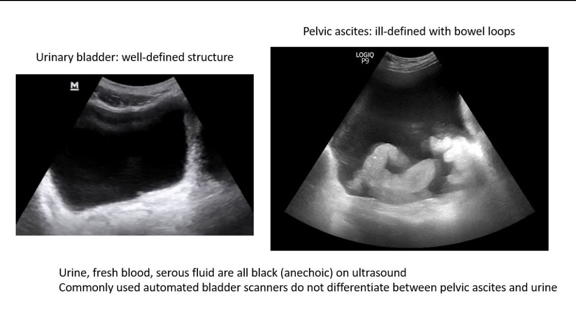 VLexpert's tweet photo. Can your #Bladderscanner tell the difference?
A non-imaging bladder scan is not reliable at times.
@ButterflyNetInc iQ+ probe has a dedicated bladder scan preset 🦋 https://t.co/hBN3rlQ0Sk