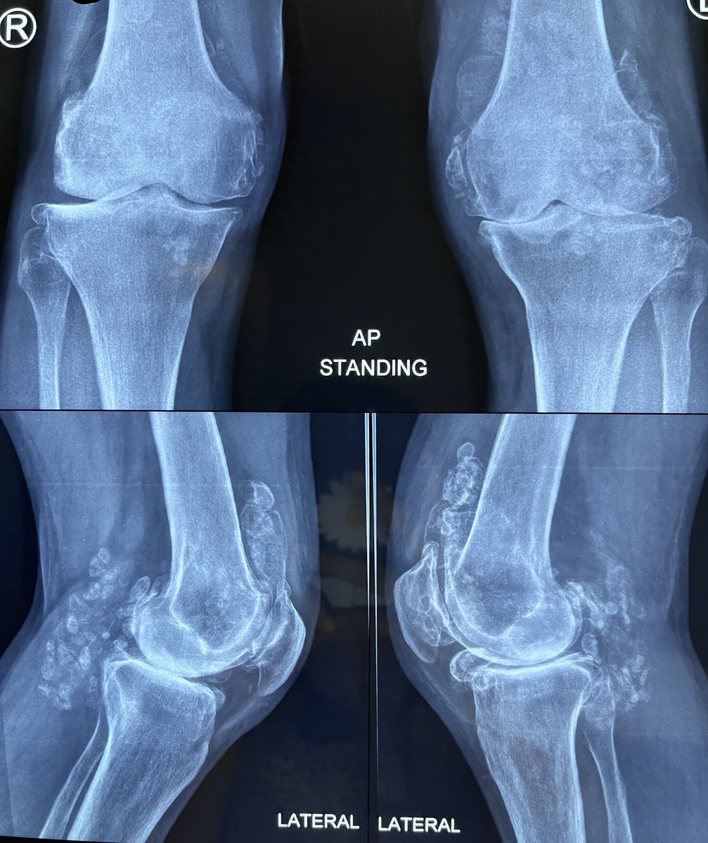prakashini_'s tweet photo. Spotter! 🔥

#imageoftheday 

40Y/M, h/o inflammatory polyarthritis for 12 years, on alternative meds.
Has sensation of intermittent locking of the knees, with swelling. 

What does the X-ray show? 

#RheumTwitter #MedTwitter #MedEd #RadioTwitter #OrthoTwitter #Radiopaedia https://t.co/jRhaki6g0D