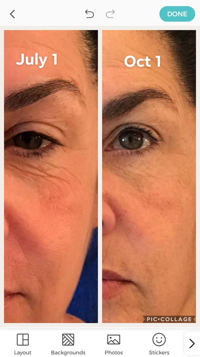 LoriMorenoCom's tweet photo. Another testimonial https://t.co/qV21RpBl7Z 
https://t.co/hOZrsoDbmk  
"I decided I would take my after picture of my thin part on top of my hair today and I am THRILLED to see these results!!! " https://t.co/VBUEjpk6Wk