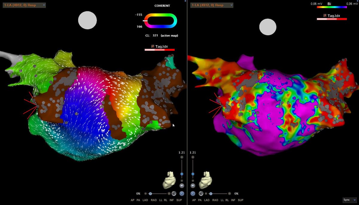 Left atrial flutter terminated at the posterior wall with single Farapulse application followed by other applications for complete posterior wall isolation