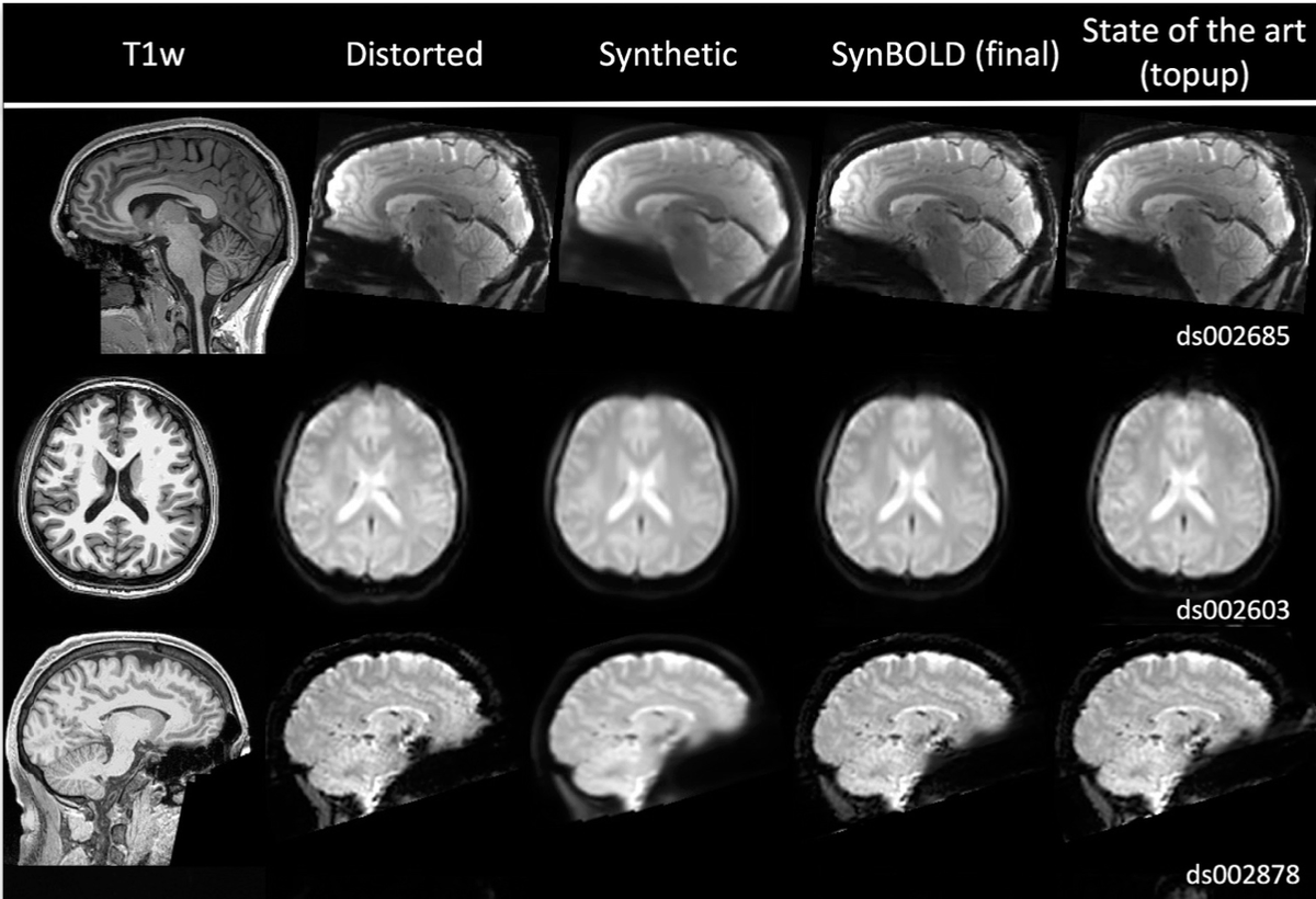 Our SynB0 distortion correction has been very well received for correcting spatial problems in diffusion weighted MRI when reverse phase encoded scans or field maps are not available. (This "should" not be a problems, but all too often is...). We now release a version for fMRI!/1