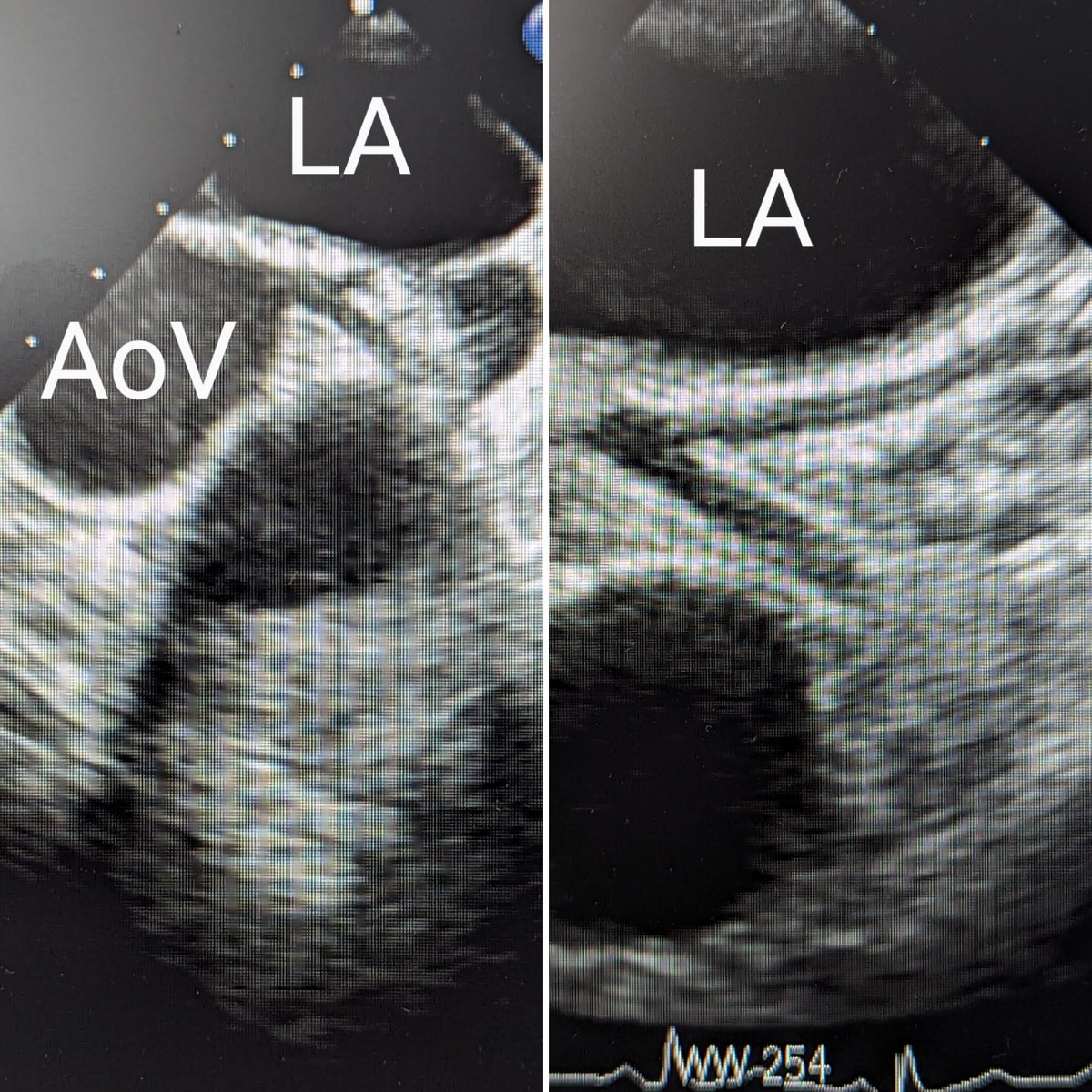 Why #IVUS? I think it is safe to say this Pat has no prognostic relevant CAD..😂
 #echofirst #toe <a href="/AGIKinterv/">AGIK</a> <a href="/Echo_DGK_GER/">AG5-Kardiovaskulärer Ultraschall</a> <a href="/Arianit_P/">Arianit Pula</a> <a href="/vlacho13/">Dr. Marios Vlachojannis</a> <a href="/TSchneiderMD/">Tilman Schneider</a> <a href="/NMerke/">Nicolas Merke</a> <a href="/echo_stepbystep/">Vladyslav Kavalerchyk 🇺🇦</a> <a href="/KardiologieHH/">Erik Rafflenbeul</a> <a href="/kaschenke/">Karsten Schenke 📯 @kaschenke.blsky.social</a>
