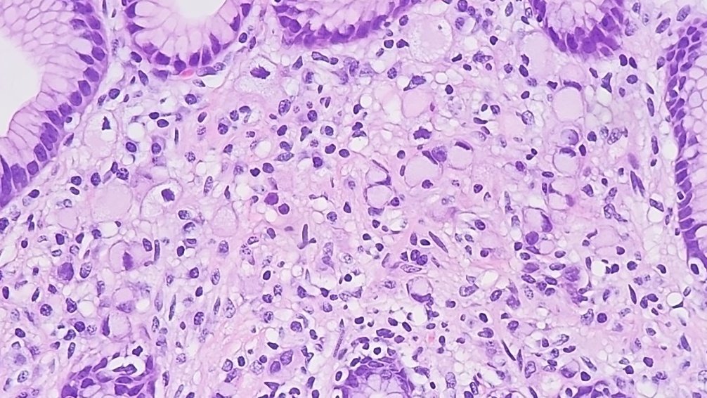Total gastrectomy from pt with CDH1 germline mutation. 

🦅👀 Courtesy of Dr. Dipti Karamchandani.

#pathology #GIpath #PathTwitter