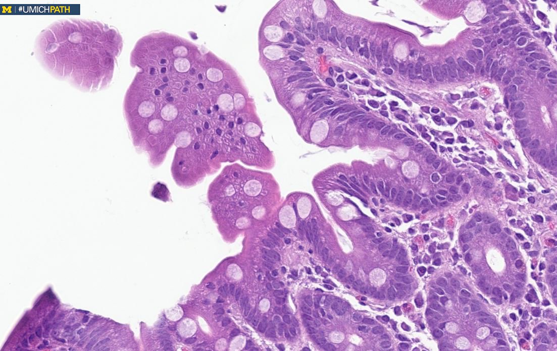Check out @IMHolmes_DO's #COTW! 35-year-old female with a history of irritable bowel syndrome undergoes a small intestine biopsy which shows the following: What do you see? What’s your diagnosis?