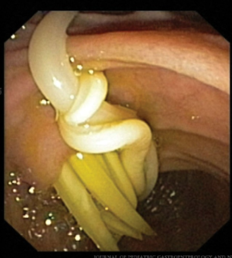 JPGNonline's tweet image. 3 yo boy with abd pain and fever for the last 10 days.  Abd US shows a dilated CBD and echogenic content. Side viewing endoscopy and cholangiography as shown.

What is the next step in management?

Answer and learn more 👉 bit.ly/3htf9YP?utm_so…

#imageofthemonth #quickpoll