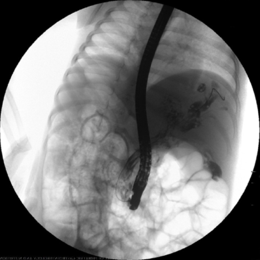 JPGNonline's tweet image. 3 yo boy with abd pain and fever for the last 10 days.  Abd US shows a dilated CBD and echogenic content. Side viewing endoscopy and cholangiography as shown.

What is the next step in management?

Answer and learn more 👉 bit.ly/3htf9YP?utm_so…

#imageofthemonth #quickpoll
