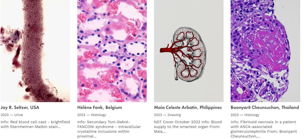 🥳NDT is proud to present the new NDT Art Gallery! era-online.org/ndt-kidney-art… 😍This collection of stunning images submitted by our most creative readers & artists offers a unique glimpse into our amazing kidneys! 👌Selected images will appear on the covers of NDT & more to come!