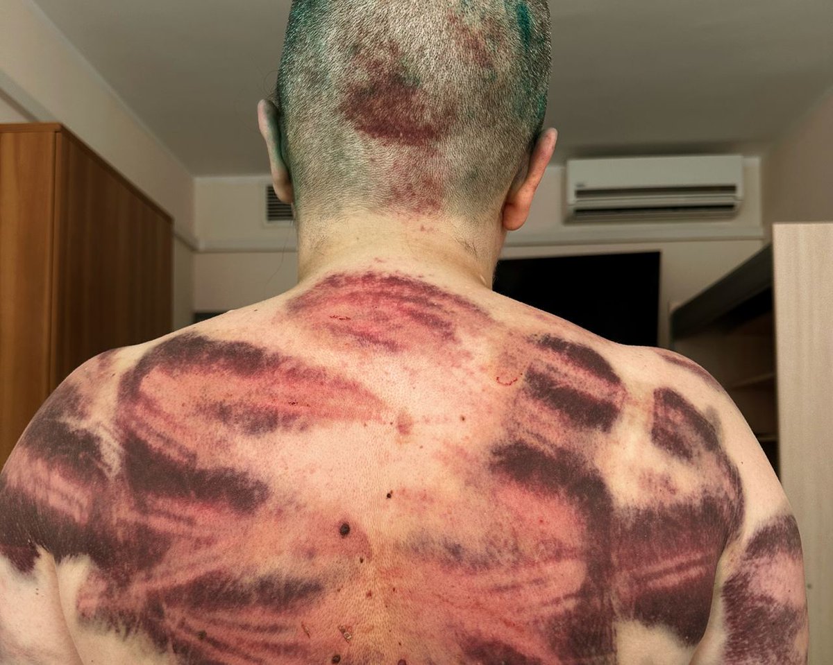 Елена Милашина показала следы побоев на теле после избиения в Чечне. Она прошла обследование в медицинской клинике Москвы.

Диагнозы: закрытая черепно-мозговой травма, множественные переломы костей кистей рук (до 14), множественные ушибы мягких тканей. Сознание ясное, состояние