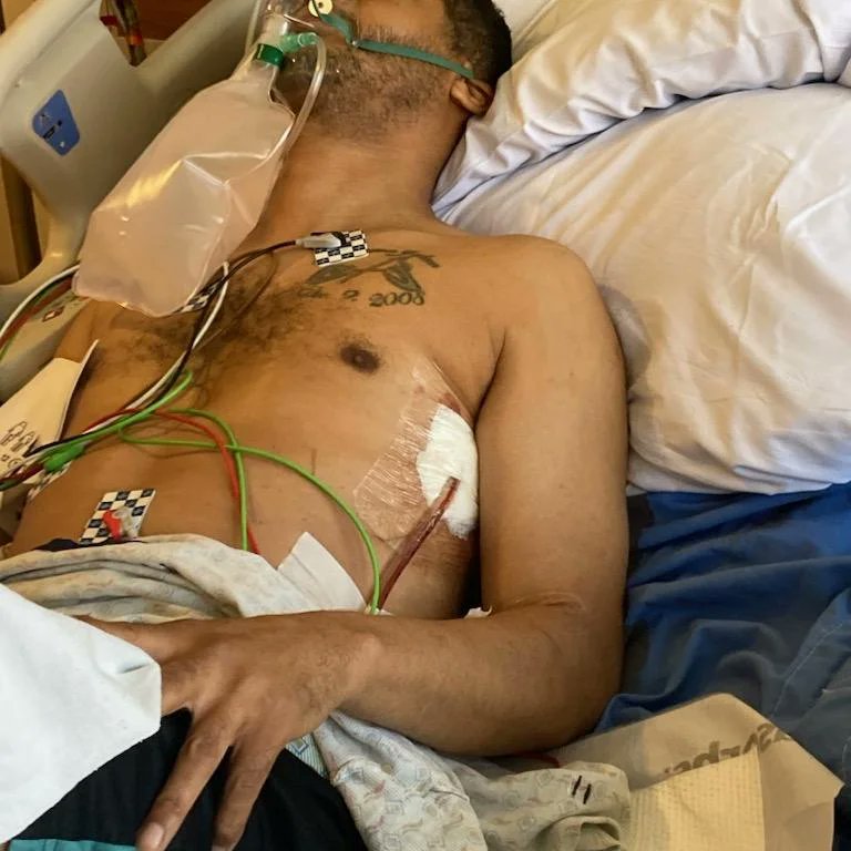 6 broken ribs and a collapsed lung later...how I spent my 4th of July! The things I do to stop smoking LOL. Recovery time: 6 weeks
(Car went thru a stop sign and didn't see me. Yes they got away)