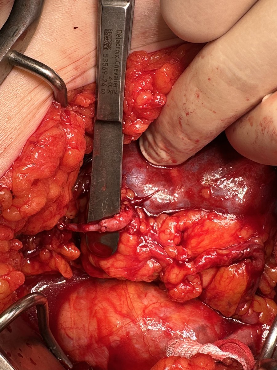 Tips and tricks on #renal #transplantation. Renal inferior polar artery anastomosed to inferior epigastric artery. Working well for renal transplant with multiple arteries. <a href="/P_Baloche/">Paul BALOCHE</a> <a href="/SzablaNicolas/">Szabla Nicolas</a> @CHU_Caen