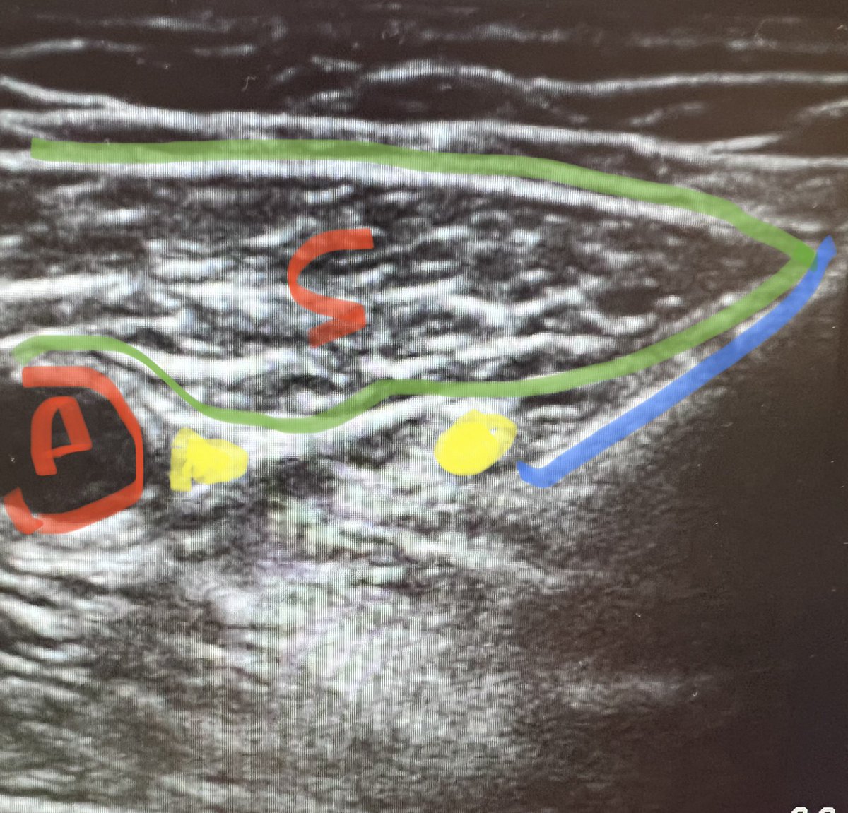 Femoral triangle block. 
NVM highlighted with saline hydrodissection just above needle tip.
Saph Nv. right next to artery