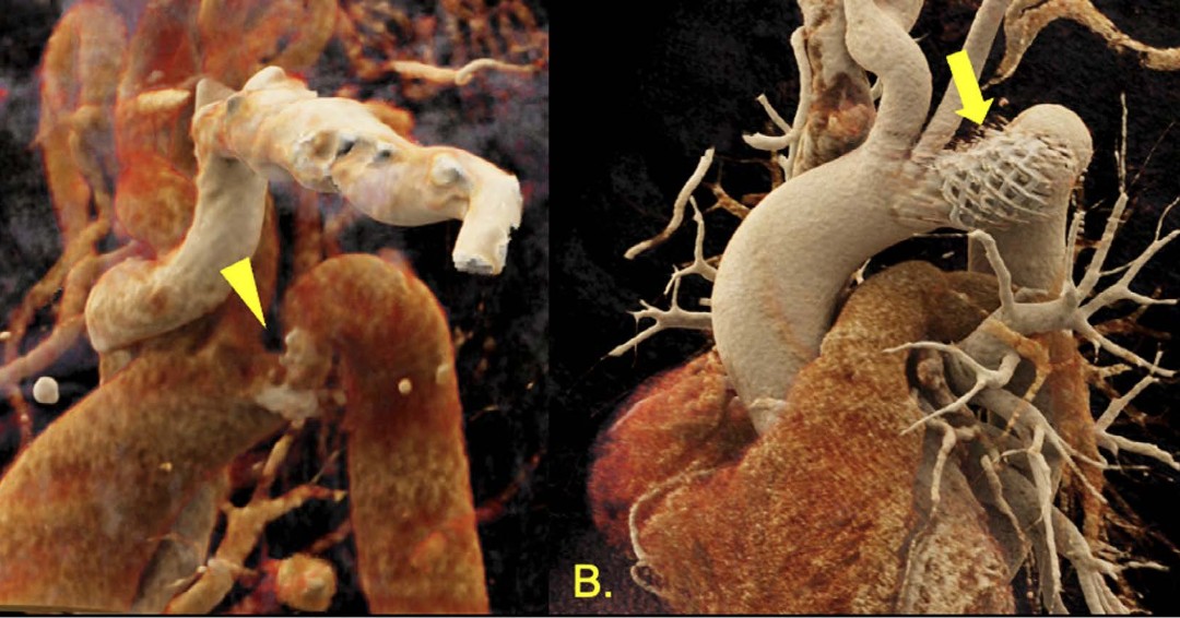 As the population of patients with #ACHD grows, the potential need for transcatheter interventions increases. "Percutaneous Structural Interventions in Adult Congenital Heart Disease" by <a href="/Rody_BouChaaya/">Rody Bou Chaaya</a> <a href="/zzbaus/">Zhihao Zhu</a> <a href="/valeriaduarteMD/">Valeria Duarte MD MPH</a> <a href="/HuieLin/">C. Huie Lin MD, PhD</a> 

#DeBakeyCVJournal doi.org/10.14797/mdcvj…