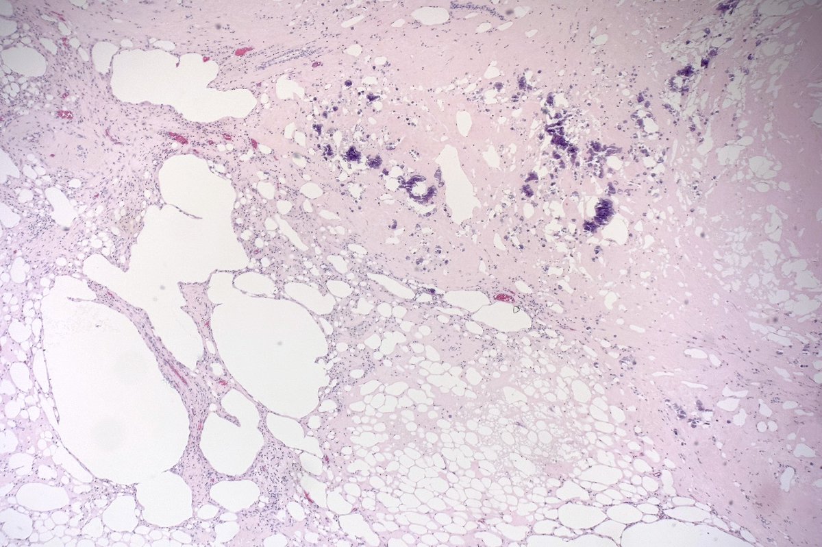 MBBS_Pathology's tweet photo. A florid example of fat necrosis with dystrophic calcification
#PathTwitter
#pathology https://t.co/PpxdeYimQE