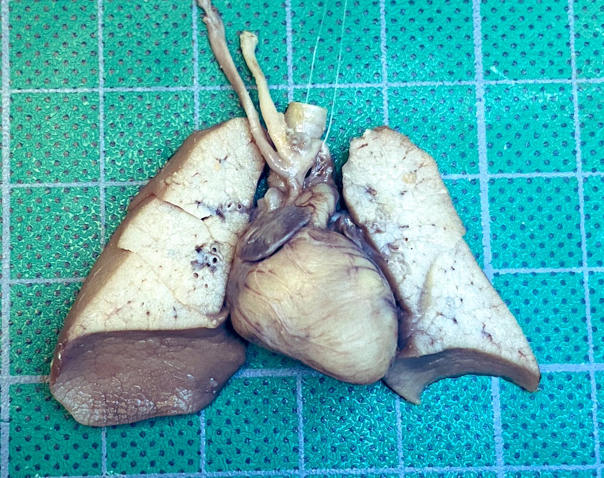 Hypoplastic left heart syndrome (HLHS) look at the tiny aorta vs pulmonar artery #PediPath #CardiacPath