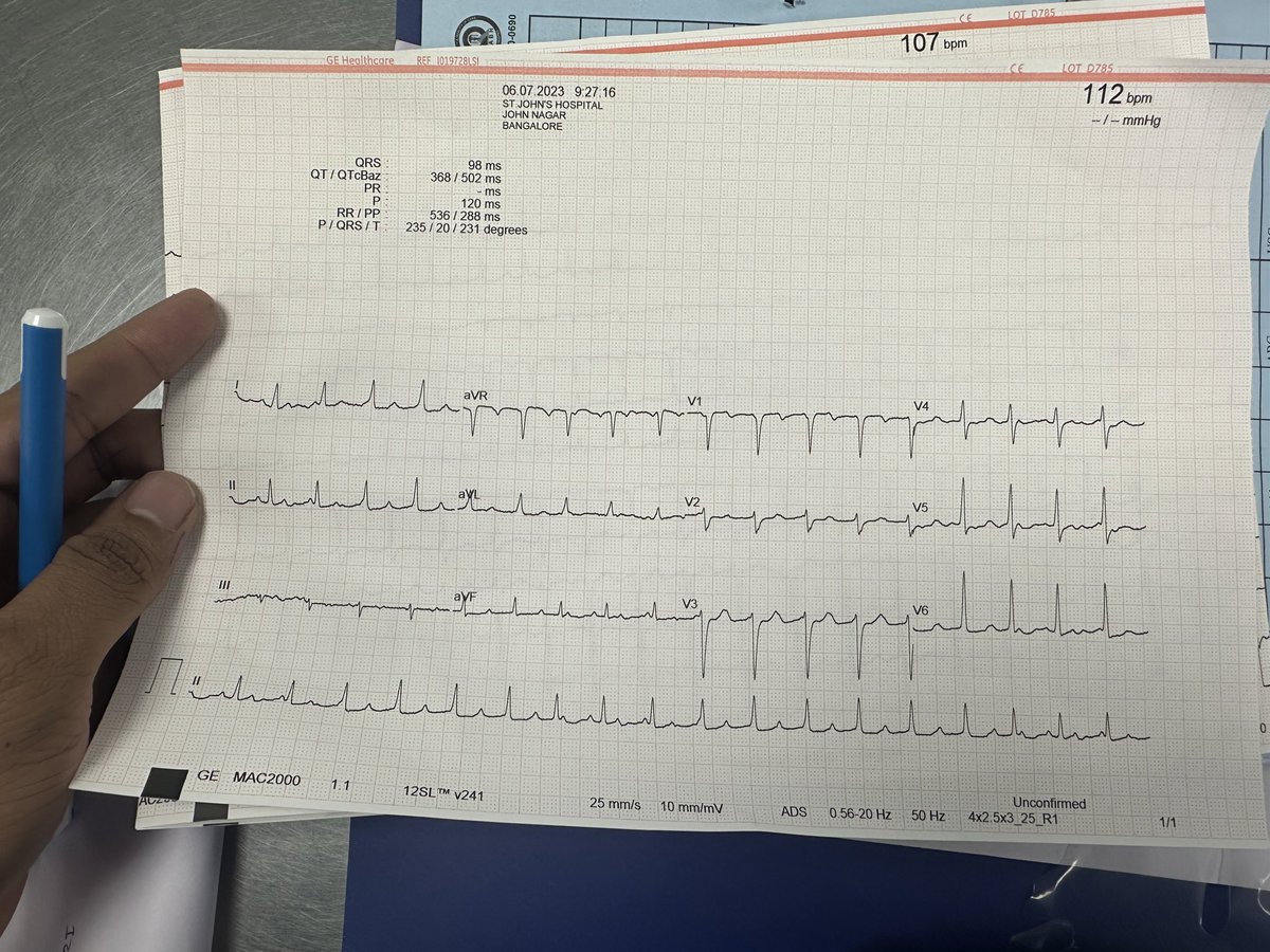 Santhrupth22's tweet photo. 45Y/F RHD, S/P MVR in 2016 currently presented with b/l lower limb selling , Occasional breathlessness,no cardiac complaints.inputs please.
@DidlakeDW @EcgOxford @ecgrhythms @EM_RESUS @Jagdish26039718 @The_Nanashi_O @EKGest @BrooksWalsh @GangoliBorun https://t.co/fTwo4lYew5