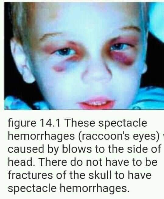 LOCULTODELMUND's tweet photo. PANDA EYES ⚠️
Aquí vemos a la ABOMINABLE PEDOFILIA  , OJOS DE PANDA es el lenguaje que usan los PEDOFILOS para los niños que han sido sodomizados (ultrajados,violados por el ano). #pizzagate #pedofilos #traficodeniños #illuminatis https://t.co/Hh0tBlM7cv
