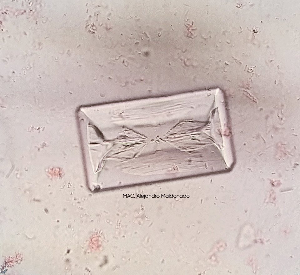 Alejandro Maldonado (@macalejandromal) on Twitter photo Fosfato Amonico Magnesico
Microscopia de campo claro con iluminación oblicua
#Urinalysis #UrineSediment #UrineMicroscopy <a href="/jrseltzer/">Jay R. Seltzer</a> <a href="/FeerMadrigalM/">TheChemistry ☣️🧬</a> Fosfato Amonico Magnesico
Microscopia de campo claro con iluminación oblicua
#Urinalysis #UrineSediment #UrineMicroscopy <a href="/jrseltzer/">Jay R. Seltzer</a> <a href="/FeerMadrigalM/">TheChemistry ☣️🧬</a>