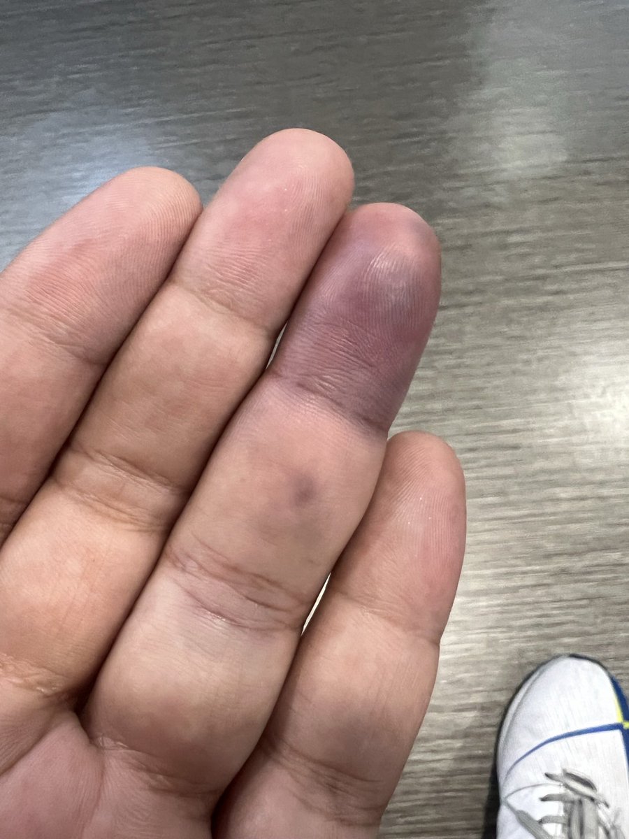 Morning therapy for fractured finger 
1. Scan and see the progress ✅
2. Go see the doc 🛎️