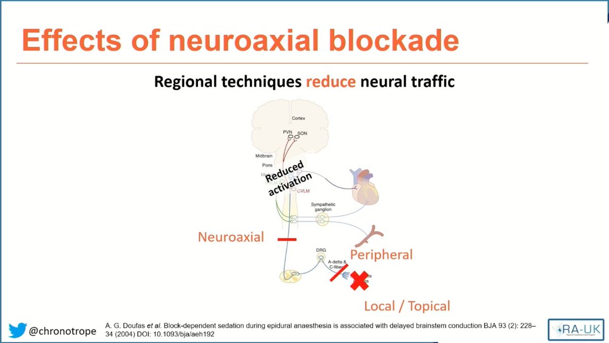 numboblivion's tweet photo. ⏺️Neuraxial anaesthesia reduces neural traffic: 

As spinal block matures ➡️decreased activation of medulla ➡️decreased activation of thalamus ➡️ decreased activation cortex ➡️ patient BIS value falls 

Often very little propofol needed for sedation (especially elderly)... 2/7 https://t.co/azGIoqvH3I