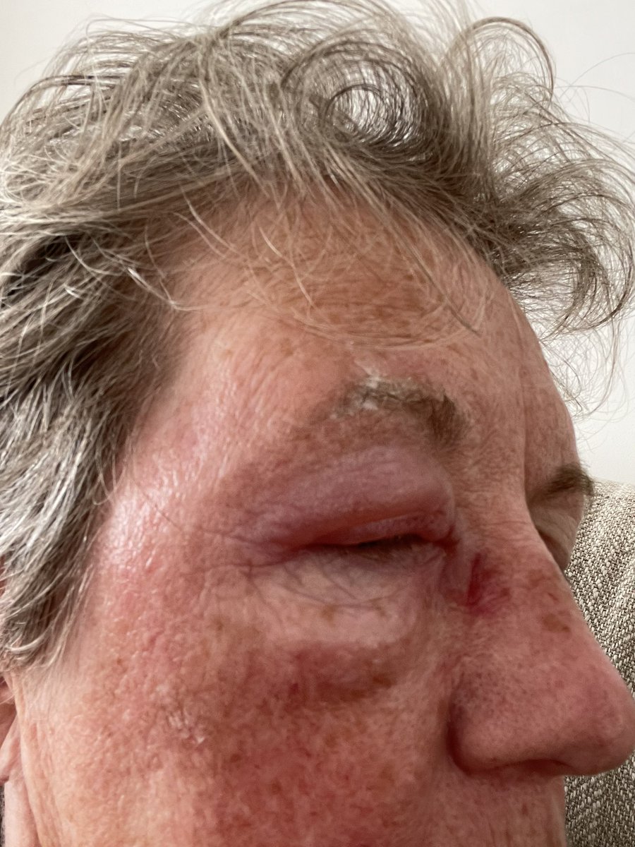 Guess who forgot the mozzie repellent for yesterday evening’s little fishing session