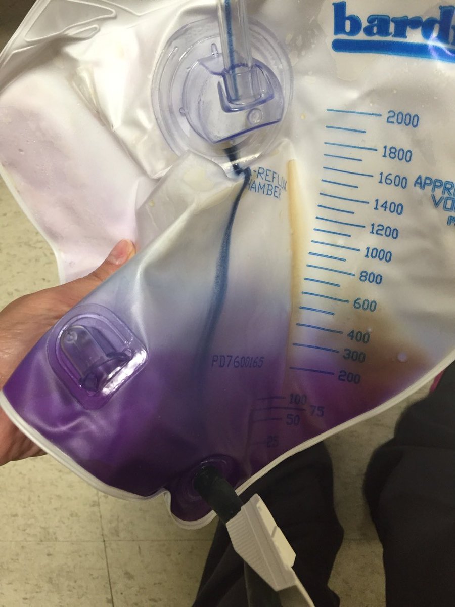 scientissimum's tweet photo. Purple urine bag syndrome (PUBS) is a medical syndrome where purple discoloration of urine occurs in people with urinary catheters and co-existent urinary tract infection. Bacteria in the urine produce the enzyme indoxyl sulfatase. This converts indoxyl sulfate in the urine into the red and blue colored compounds indirubin and indigo. The most commonly implicated bacteria are Providencia stuartii, Providencia rettgeri, Klebsiella pneumoniae, Proteus mirabilis, Escherichia coli, Morganella morganii, and Pseudomonas aeruginosa.🦠💦
.
#medtwitter #scientissimum #publichealth #icu 
credit @drkeithsiau