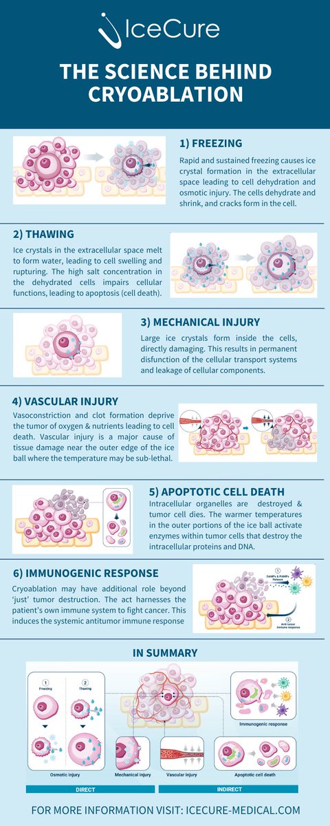 Check out this #infographic to learn the #science behind IceCure’s minimally invasive #cryoablation procedure. #interventionalradiology #interventionaloncology #womenshealth #biotech