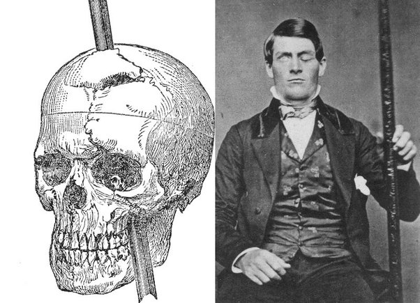 rarestorees's tweet image. Phineas Gage worked as a railway constructor in 1852. One day Gage became momentarily distracted by the men working behind him, causing him to turn around.

The iron rod Gage was holding at the time sparked against a nearby rock and ignited the fuse, causing an explosion. The rod…
