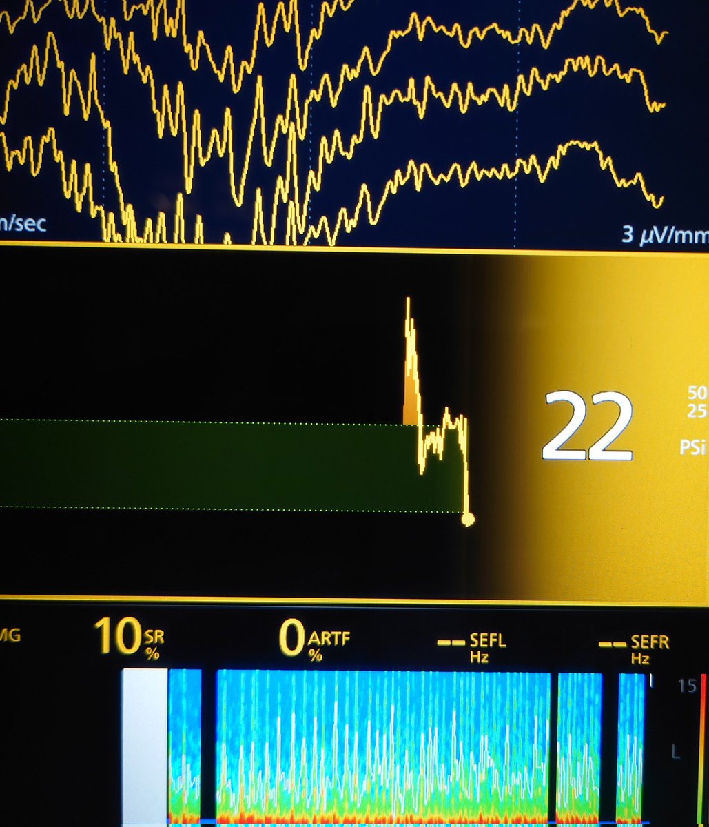 Alfentofol's tweet image. Effect of Muscle relaxant #sedline #pEEG