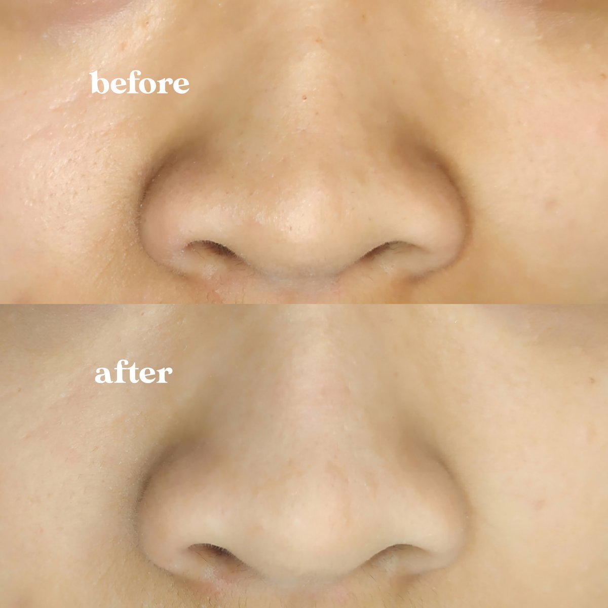 legaa bgt komedo ilang?? tim exfoliasi pake peeling gel☝🏻

lebih gampang buat ekstrak komedo + bikin tekstur kulit jd lebih haluss! sesuai namanya soft peel, beneran lembut waktu pakenyaa lebih minim iritasi✅✅

#racuninskincare