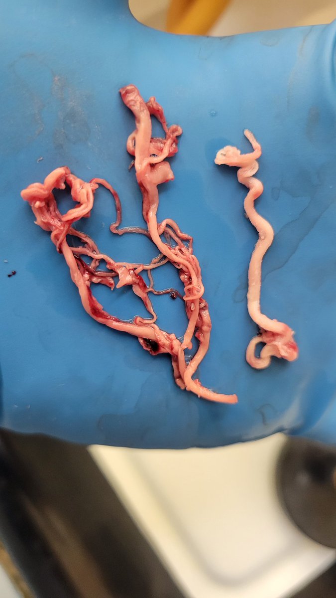 SiddeshGulla's tweet photo. @ruggedhacksaw @LooksfarB @amorettarita11 @r_hirschman These could be from coronary vessels of the heart itself https://t.co/ZzDEOUiTSZ