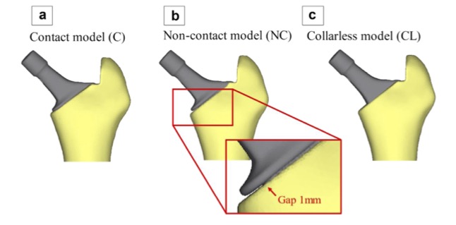 Arthroplasty Today (@arthrotoday) on Twitter photo Does a collar increase femoral implant stability in THA? This biomechanical study used finite element models to look at stability of cementless collared & collarless stems under diff loading conditions. #orthotwitter <a href="/FidelerKateMD/">Kate Fideler, MD MPH</a> <a href="/paul_lichstein/">Paul M Lichstein, MD,MS</a>
arthroplastytoday.org/article/S2352-… Does a collar increase femoral implant stability in THA? This biomechanical study used finite element models to look at stability of cementless collared & collarless stems under diff loading conditions. #orthotwitter <a href="/FidelerKateMD/">Kate Fideler, MD MPH</a> <a href="/paul_lichstein/">Paul M Lichstein, MD,MS</a>
arthroplastytoday.org/article/S2352-…