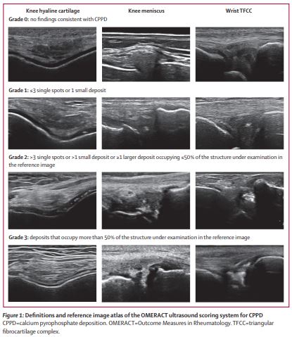 NEW RESEARCH—Development and validation of an <a href="/OMERACT/">OMERACT</a> ultrasound scoring system for the extent of calcium pyrophosphate crystal deposition at the joint level and patient level; the scoring system is reliable on both static images and patients thelancet.com/journals/lanrh… #CPPD