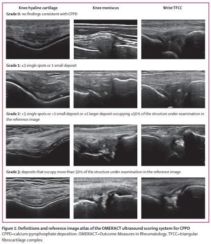 NEW RESEARCH—Development and validation of an @OMERACT ultrasound scoring system for the extent of calcium pyrophosphate crystal deposition at the joint level and patient level; the scoring system is reliable on both static images and patients thelancet.com/journals/lanrh… #CPPD