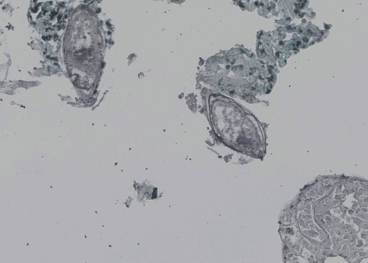 Bladder biopsy for trainees:

mayoclinicproceedings.org/article/S0025-…